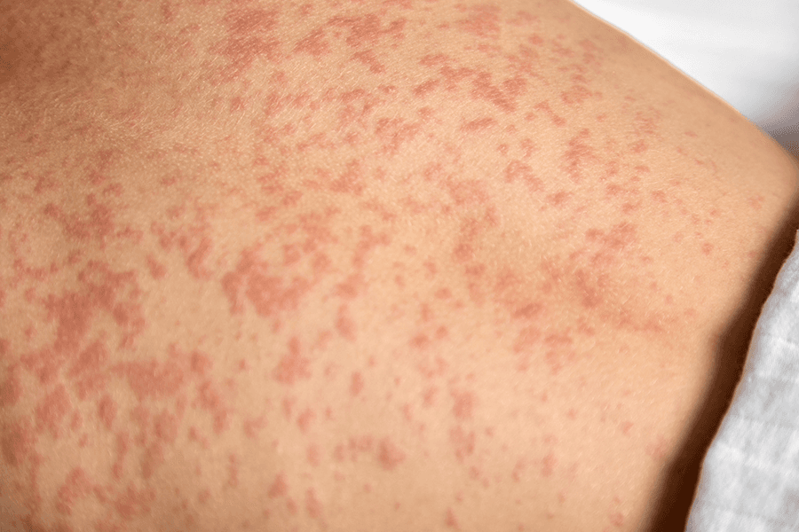 Rubella_530620661